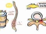 还在被脊柱病折磨？别愁，脊柱内镜技术，“小孔”治病不开刀！