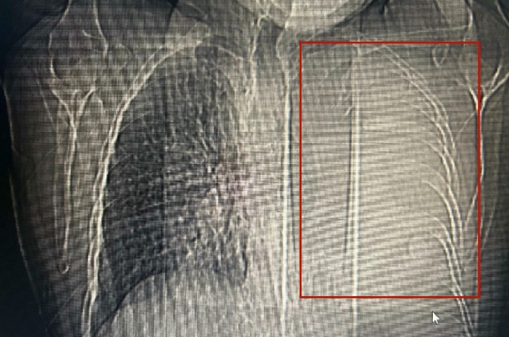 多术联合破绝境，精准诊疗焕新生丨呼吸与危重症医学科成功救治重症肺鳞癌伴完全肺不张患者